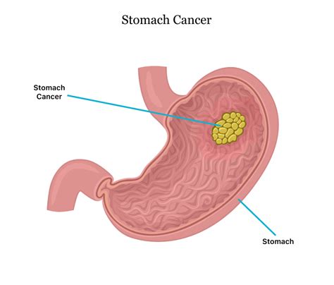 gastrid|gastric cancer.